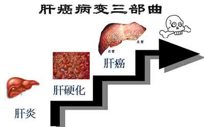 乙肝肝硬化到肝癌多长 乙肝肝硬化到肝癌多长 肝硬化转变成肝癌需要多长的时间?