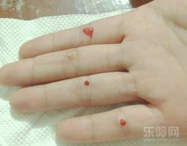 小儿厌食推拿法 点刺四缝穴配合推拿治疗小儿厌食证