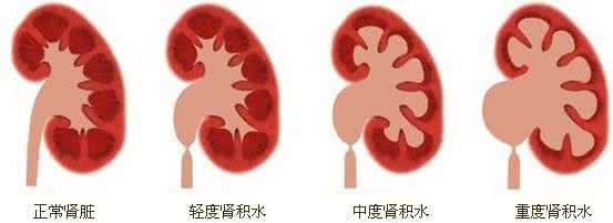 肾积水最佳治疗方法 治肾积水
