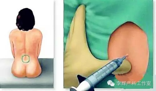 腰麻后最常见的并发症 腰麻后最常见的并发症 大鼻头改小术后常见并发症应该怎么处理
