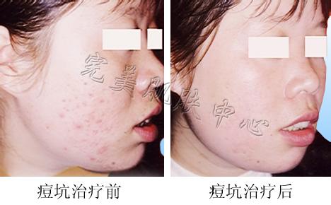 青春痘坑的治疗方法 怎么治青春痘坑