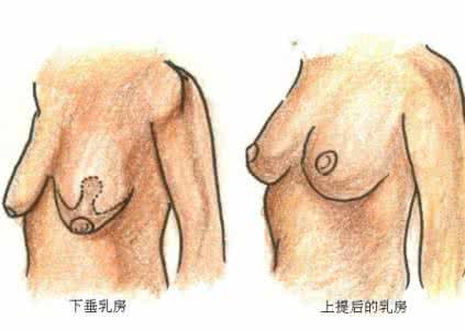 乳房下垂松软怎么办 断奶乳房下垂怎么办