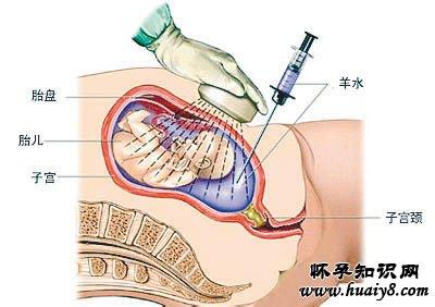 哪些人不适合羊水穿刺 羊水穿刺什么时候做
