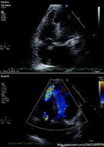 心血管造影前准备包括 E诊断：正常心血管造影表现(包括DSA)