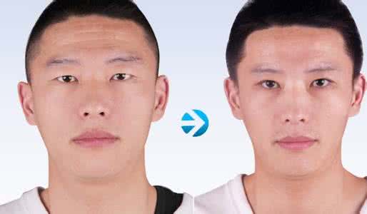 伊凡露注射除皱 伊凡露注射除皱 伊凡露注射除皱有哪些优点?