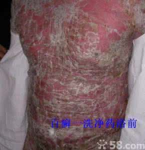 银屑病可以吃肉吗 银屑病能根治吗 银屑病能吃肉吗?