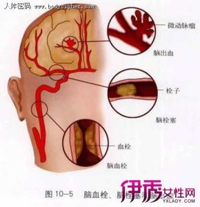 脑血栓形成的原因 脑血栓形成的原因 脑血栓形成原因 动脉粥样硬化是基本