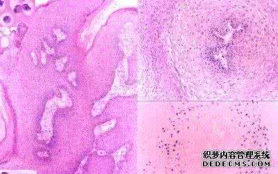 荨麻疹的治疗方法简介 尖锐湿疣的治疗方法 尖锐湿疣的治疗方法简介
