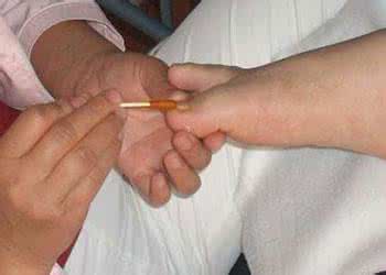 甲沟炎拔指甲 甲沟炎要不要拔指甲 病因有什么呢