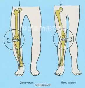 膝外翻怎么办 成人膝外翻怎么办？