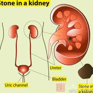 大妈在家跳广场舞漏缝 肾结石症状 广场舞大妈把肾结石给排出