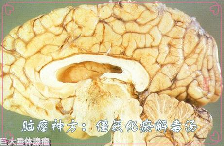 化瘀散结 解毒消肿 脑瘤神方：僵莪化瘀解毒汤