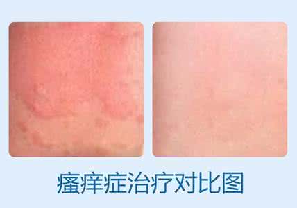 皮肤瘙痒症怎么治疗 【中西治疗】治疗各种皮肤瘙痒症良方