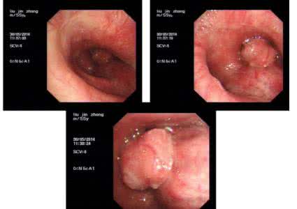 肺部肿瘤的治疗方法 肺部肿瘤的治疗方法 胸部肿瘤怎么办 胸部肿瘤的治疗方法