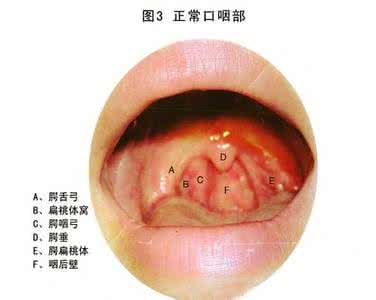 急性咽炎多久能好 急性咽喉炎多久能好 急性咽炎能彻底好吗？