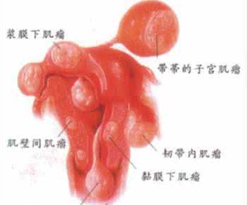 子宫肌瘤恶变的症状 子宫肌瘤恶变的症状 黑色素瘤的症状 身体这里长出黑斑极易恶变