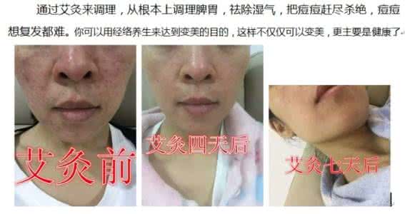 湿气重会长痘痘吗 湿气重会长痘痘吗 湿气重了会长残？来把鸡骨草！