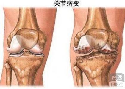 骨关节健康 如何吃出健康的骨关节