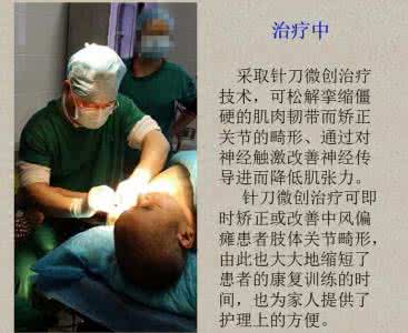 中风偏瘫特效治疗法 中风偏瘫，“治瘫点”是最方便的疗法