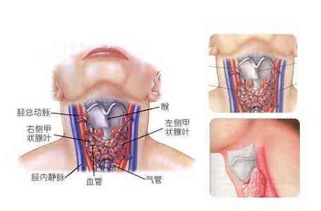 咳嗽厉害了会怎样 成人咳嗽的克星——买氏奇穴多维微痛疗法