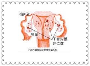 子宫移位严重吗 子宫移位