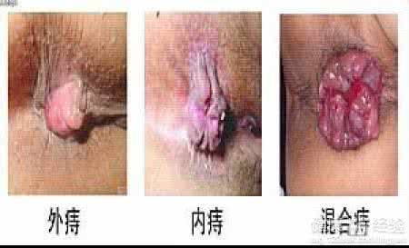 治疗痔疮外用药 痔疮外用药 正确治疗痔疮