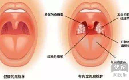 扁桃体有多大 扁桃体发炎对人体的危害有多大！何医生告诉你尤其是小孩