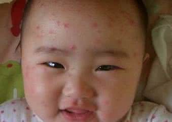 水痘患者饮食禁忌 水痘饮食禁忌 宝宝患水痘后的饮食禁忌