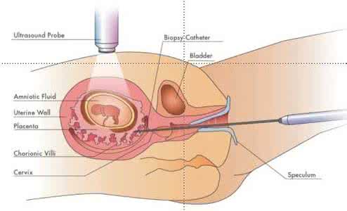 香港抽血鉴定胎儿性别 抽羊水 不安全的胎儿性别鉴定方法：羊膜腔穿刺法,俗称“抽羊水”