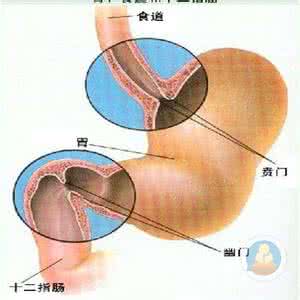 胃食管反流病的症状 胃食管反流病症状 胃食管反流病如何治疗