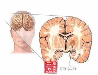 肾主骨生髓通于脑 肾生髓通脑