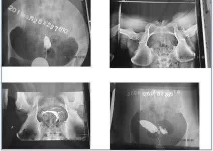子宫输卵管造影术 子宫输卵管造影术 造影怎样做 常见的造影术有哪些