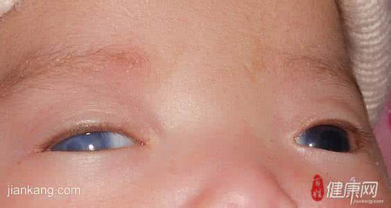 玻璃体混浊的治疗方法 玻璃体混浊能治好吗 玻璃体混浊的治疗方法