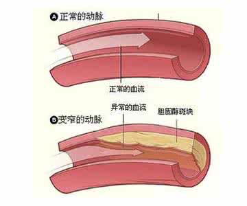 主动脉硬化怎么治疗 主动脉硬化该怎么预防和治疗？