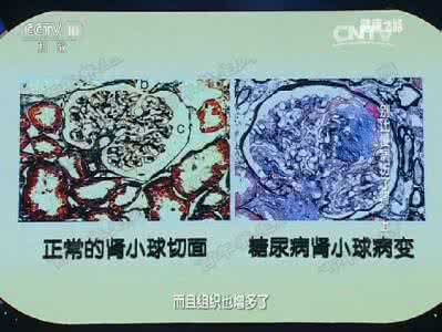 糖尿病肾病蛋白尿 20160704健康之路视频和笔记:周福德,糖尿病,蛋白尿,糖尿病肾病