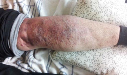 拍打拉筋治中风后遗 中风后遗拍打拉筋