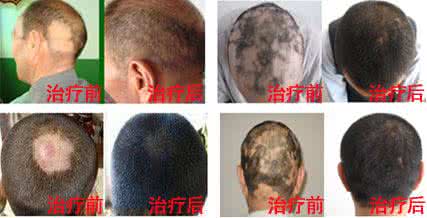 治疗斑秃最好方法 治疗斑秃用什么方法 治疗斑秃有什么好方法