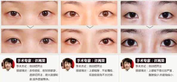 做双眼皮手术哪里好 做双眼皮手术好吗 做双眼皮手术哪里好