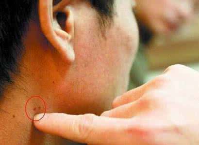 感冒和艾滋病症状区别 艾滋病的症状犹如感冒 需高度警惕