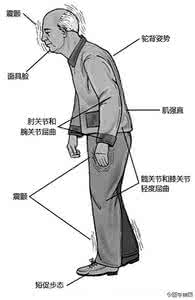 帕金森电极手术报销 一块电极能治帕金森 大病报销后只负担4万元