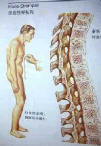 骨痹什么意思 骨痹