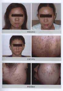 怎样快速治疗痤疮 食疗治痤疮怎么样 痤疮的危害后果是什么呢