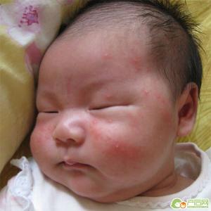 婴儿湿疹最佳治疗方法 婴儿湿疹最佳治疗方法 治疗婴儿湿疹最佳的方法