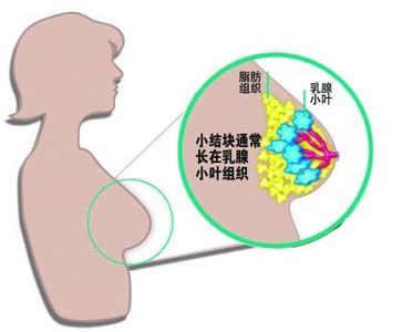 乳腺癌的诱因 压力大生育晚是乳腺癌的诱因