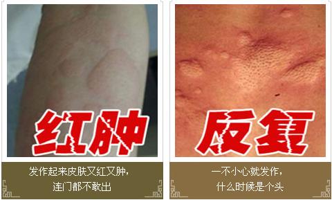 荨麻疹的症状和图片 荨麻疹症状图片哪里有 有哪些症状