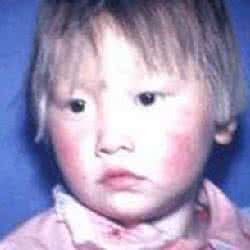 苯丙酮尿症的症状 PKU苯丙酮尿症的症状