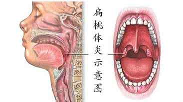 急性化脓性扁桃体炎 急性化脓性扁桃体炎 如何治疗它