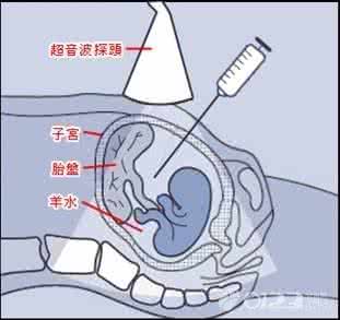 羊水穿刺费用能报销吗 羊水穿刺疼吗