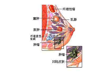 乳腺纤维腺瘤的治疗 乳腺增生与乳腺纤维腺瘤的差异