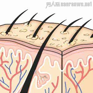 干性头皮屑怎样去屑 男人要学会几种头皮保养和去屑的方法